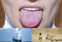 Home remedies for geographic tongue