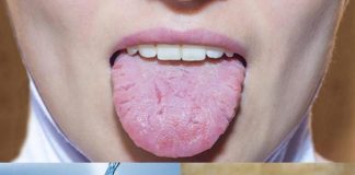 Home remedies for geographic tongue